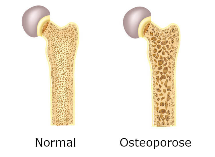 mohnoel gegen osteoporose